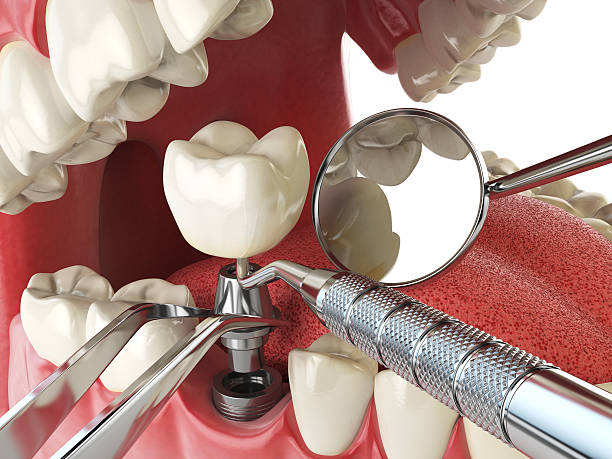 Best Emergency Dentist for Lost Fillings or Crowns in South Sioux City, NE